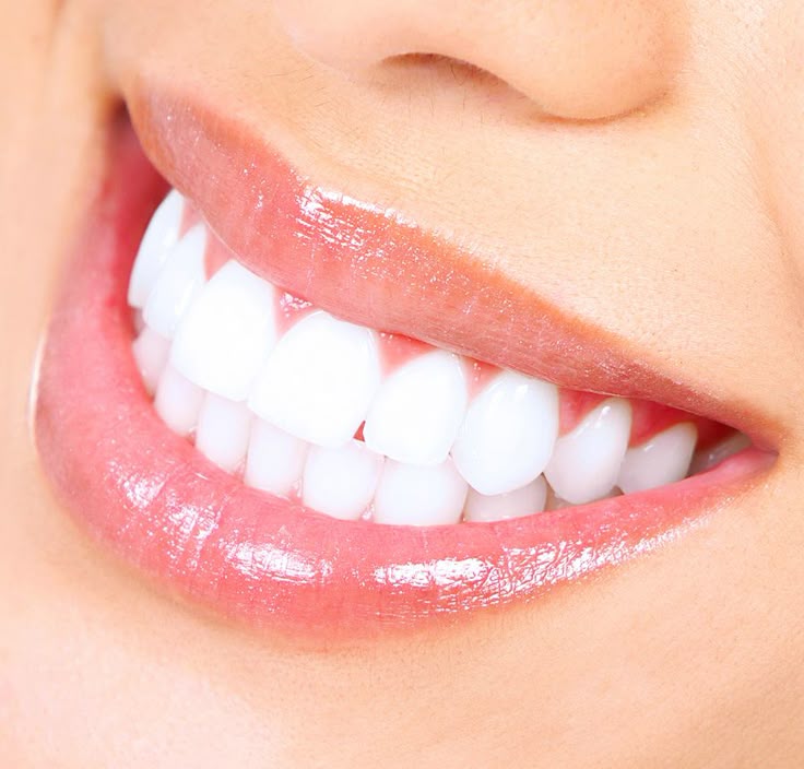 Dental Bleaching Teeth Whitening